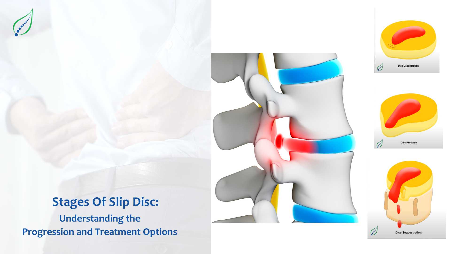 Stages Of Slip Disc: Understanding the Progression and Treatment Options